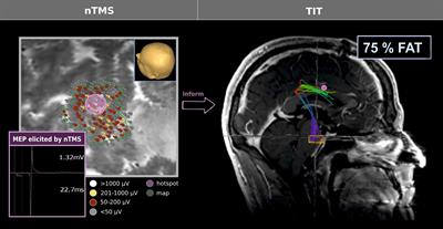 Surgery of Motor Eloquent Glioblastoma Guided by TMS-Informed Tractography: Driving Resection Completeness Towards Prolonged Survival